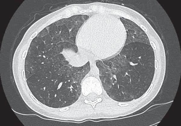 The disease does not appear to recur after pulmonary transplantation [89].