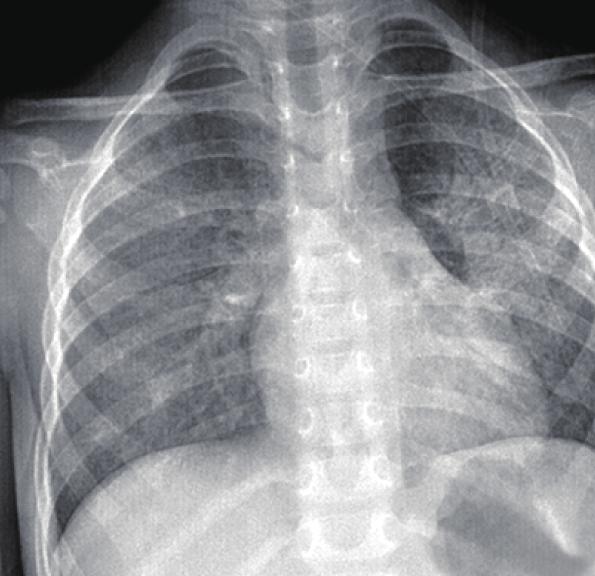 Unclassified Interstitial Pneumonia With Fibrosis AAIR history of cough and dyspnea. He had had a mild cough for 1 week before a sudden deterioration in his condition.