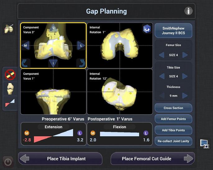 Interactive Views Four interactive views for translating and rotating the components with respect to the patient s virtualized joint.