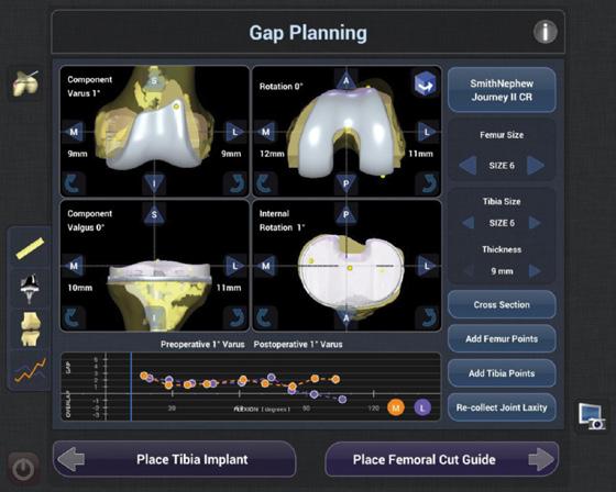 Gap Graph Gap Graph toggle button Toggle the right two viewscreens to the sagittal plane of view by pressing the Rotate View arrow button Use the implant position controls to change the position in