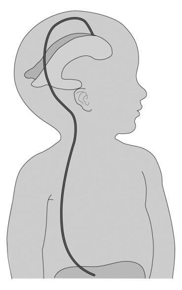 Disorders of the nervous system and their treatments Hydrocephalus Hydro- cephal -us Define the terms.