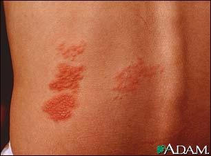 Shingles This photograph shows clusters of blisters (vesicles) and redness (erythema) caused by herpes zoster (shingles).