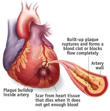 the blockage, is deprived of oxygen and nutrients when these two things happen: When cholesterol plaque accumulates to the point of blocking the flow of blood through a coronary artery.