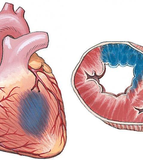 Heart Attack Definition: Coronary artery or a branch of the coronary artery is blocked.
