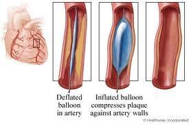 Angioplasty Definition: procedure that pushes plaque against