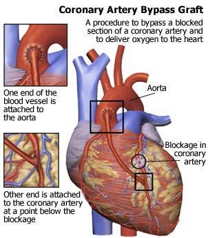 Bypass Surgery Definition: taking arteries/veins from other parts of
