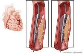 Atherectomy Similar to angioplasty except that the catheter has