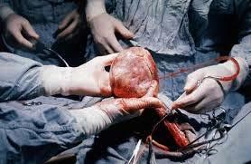 Heart transplant Removes a diseased heart and replaces it with a healthy