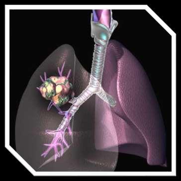 Lung Cancer The uncontrolled and invasive growth of abnormal cells within the lungs.