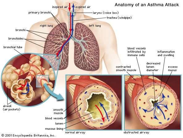 Asthma A disease where the airways and lungs of a person can become obstructed because they narrow and cut off air flow.