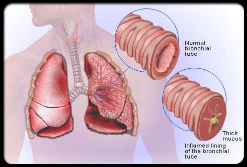 Bronchitis A condition where the bronchioles become inflamed and filled with mucus resulting in a reduction of air flow