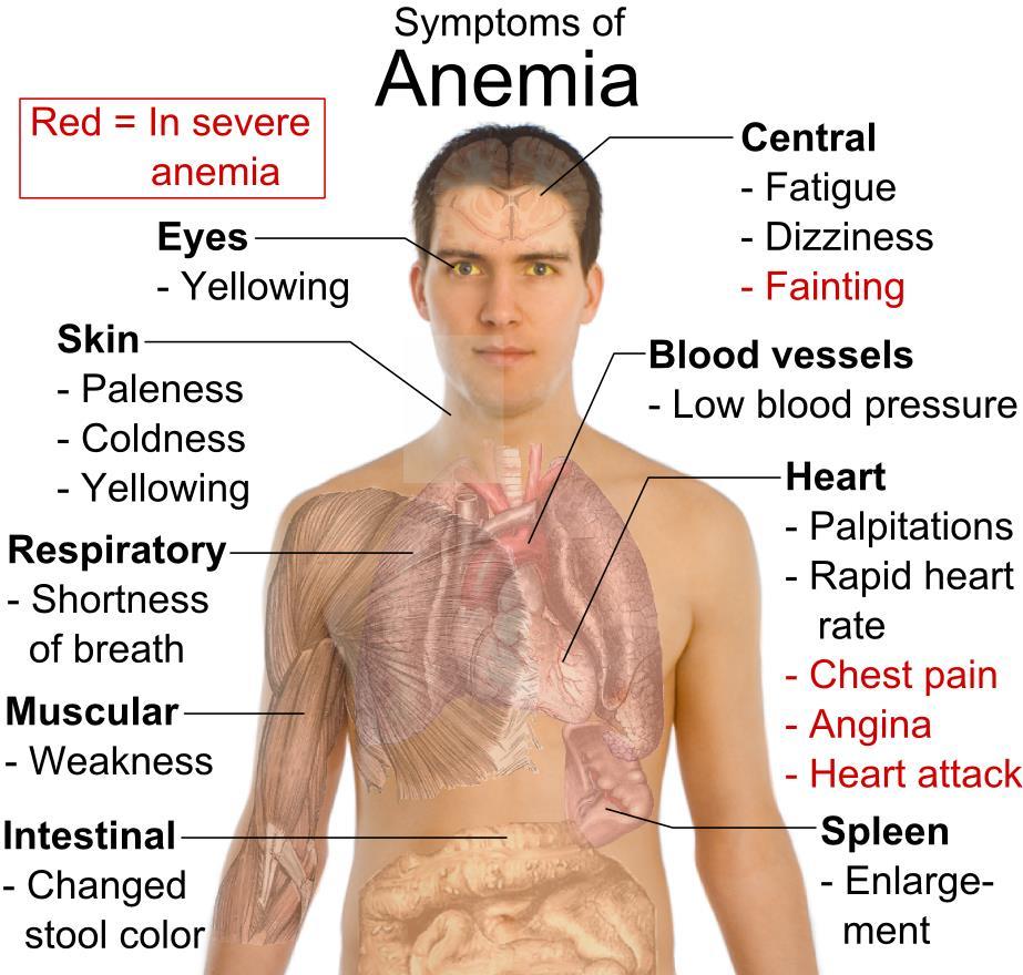 Blood Disorders Anemia is a deficiency in the number of RBC s and the amount of Hgb in the blood.