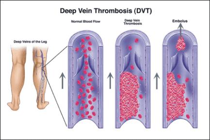 Blood disorders Thrombosis formation of a blood clot in a blood vessel Blood clot is a Thrombus Embolism air, blood clot, cancer cells, fat, etc.
