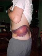 Blood disorders Contusion injury causing soft