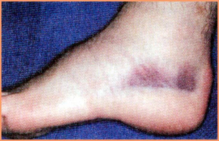 Hematoma localized clotted mass of blood found in