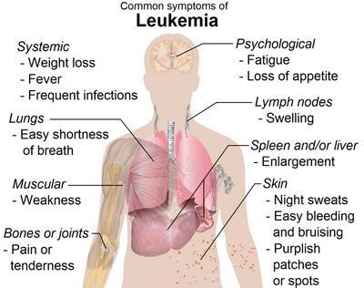 Blood disorders Leukemia - Over production of immature WBC s Symptoms: fevers, night sweats, fatigue, headaches,