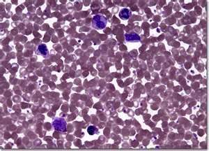 Blood disorders Polycythemia - Too many red blood cells are formed. May be a temporary condition that occurs at high altitudes.