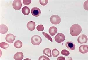 Blood disorders Sickle cell anemia