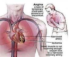 Circulatory disorders Angina pectoris severe chest pain occurring when the heart does not receive enough O2 Is a symptom of an underlying problem with coronary circulation.