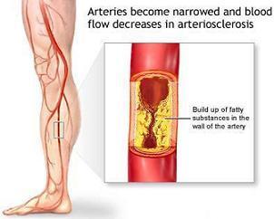Circulatory disorders Arteriosclerosishardening or thickening of