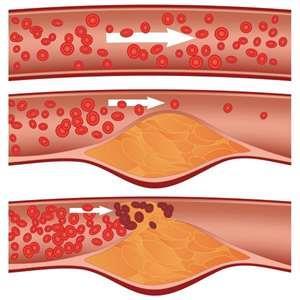 Circulatory disorders Atherosclerosis- fatty plaques, frequently cholesterol, deposited