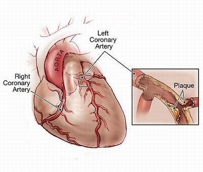 Circulatory disorders Coronary artery disease (CAD)/Heart disease Narrowing of