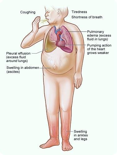 Circulatory disorders Heart failure When the ventricles of the heart