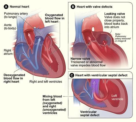 Circulatory disorders Murmurs is an extra or unusual sound heard during a heartbeat.
