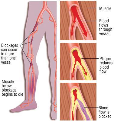 Circulatory disorders Peripheral vascular disease Blockage of the arteries (usually in the legs) Symptoms pain/cramping in legs or buttocks