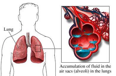 Circulatory disorders Pulmonary edema Excess fluid in the