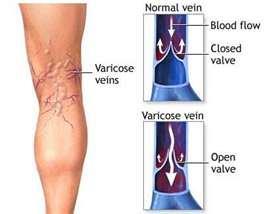 Circulatory disorders Varicose veins Swollen veins that come from slow blood flow back to heart Causes: hereditary weakness