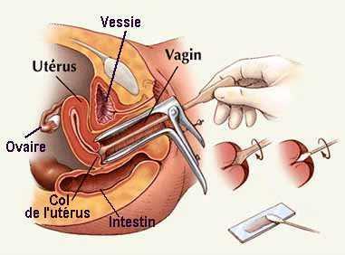 allows sperm to pass through Pap Smear