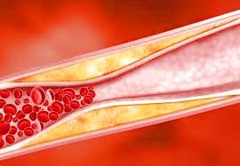 ATHEROSCLEROSIS WHAT IS ATHEROSCLEROSIS? Atherosclerosis is a narrowing of the arteries that can significantly reduce the blood supply to vital organs such as the heart, brain and intestines.