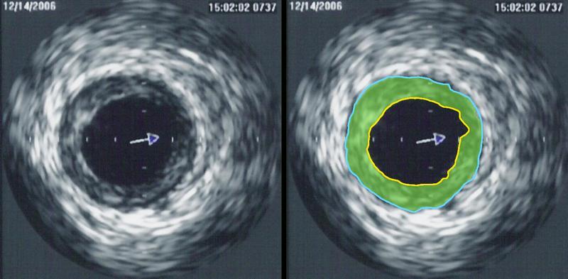 Figure 9 Intravascular ultrasound image of a coronary artery (left), with color coding on the right, delineating the lumen (yellow), external elastic membrane (blue) and the atherosclerotic plaque