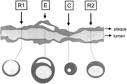 Figure 1. Schematic presentation of the different remodeling modes. The mode and extent of arterial remodeling is mostly based on a comparison with 1 or 2 reference sites.