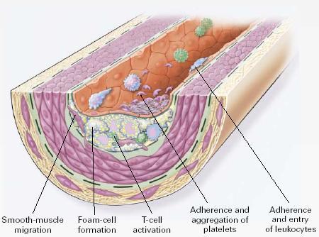 The inflammatory pathogenesis of atherosclerosis Endothelial dysfunction: monocyte adhesion Formation of fatty-streak lesions Fibroproliferative growth Unstable plaque: rupture & thrombosis R.