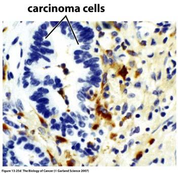 Macrophages in human colorectal carcinoma produce MMP-9 (brown) a key