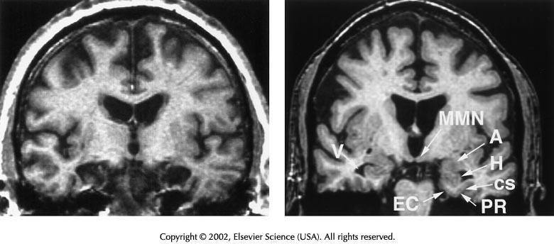 MRI scan of H.M. and control brain H.