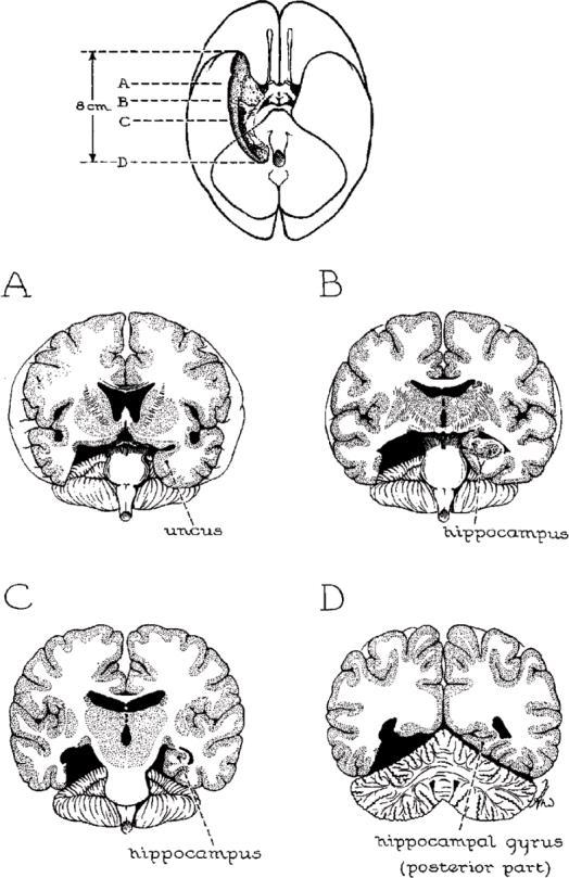 MRI of HM s Brain lesions Surgeon s Estimate of H.