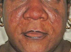 Rosacea Is a Chronic Inflammatory Skin Disease Understanding of this disease is evolving 1 Complex pathophysiology 1