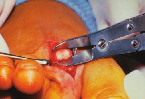 CHAPTER 17 79 Figure 1. A bone cutting forceps is utilized to remove the cartilage on the head of the proximal phalanx.