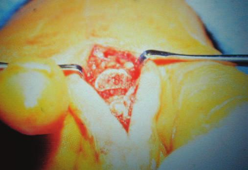 Depending on the size of the toe, this typically takes two to four swipes for complete cartilage resection. Figure 3.