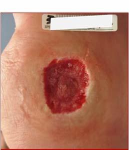 assess the depth of wound and the condition of surrounding tissue To remove the physical barrier to healing and reduce bacterial growth To adequately prepare for advanced agents, CTPs Recommended in