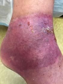 orthopedist as she had total knee replacement He debrided the eschar leaving
