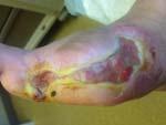 Importance of Aggressive Wound Management for Chronic Wounds