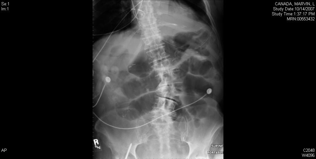 Dilated loops of small bowel consistent with ileus - distended stomach Dilated bowel loops suspicious for SBO.