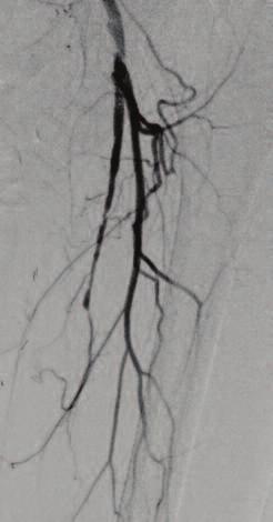 A B C D Transcollateral Approach for Complex SFA CTO E F G H