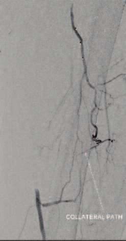 (D) Fielder wire and QuickCross in distal SFA via collateral.