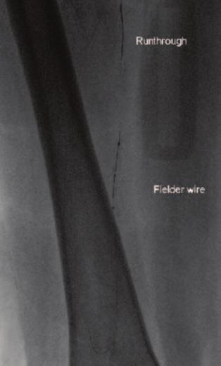 0 TurboElite Laser fiber (Spectranetics ) was then utilized to debulk and modify the plaque as well as facilitate balloon