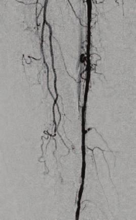 An Omni catheter was used to cross over to the left side and the sheath was exchanged for a 45 cm, 6 Fr destination sheath (Terumo) placed in the right common femoral artery.